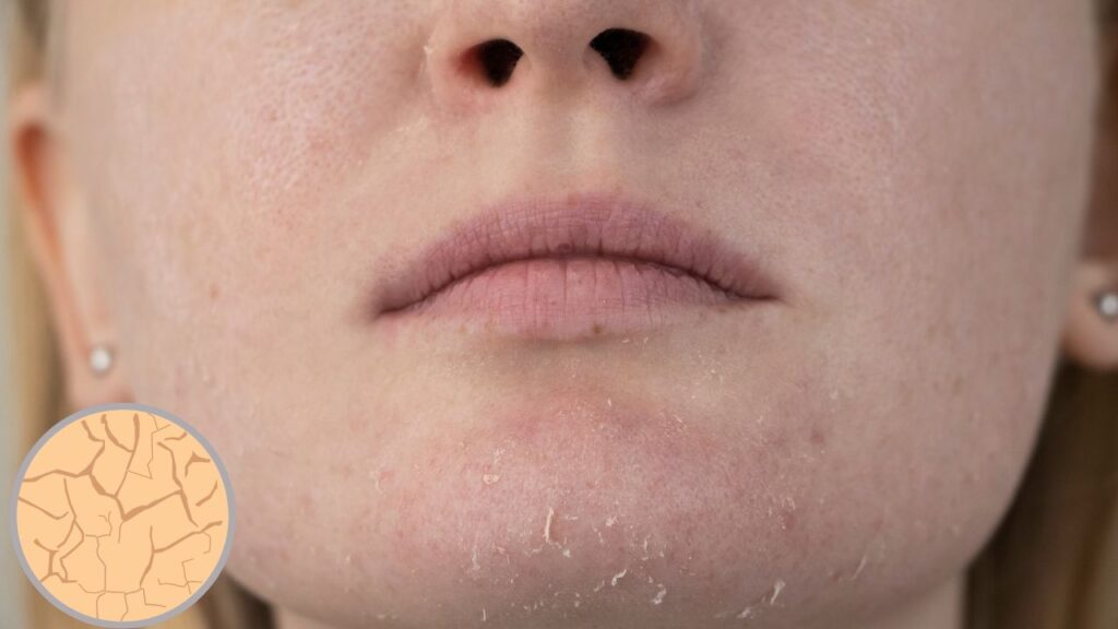Dry Skin: Symptoms, Causes, and Solutions