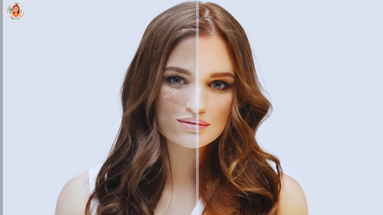 Due to deficiency of which vitamin the face becomes dark?