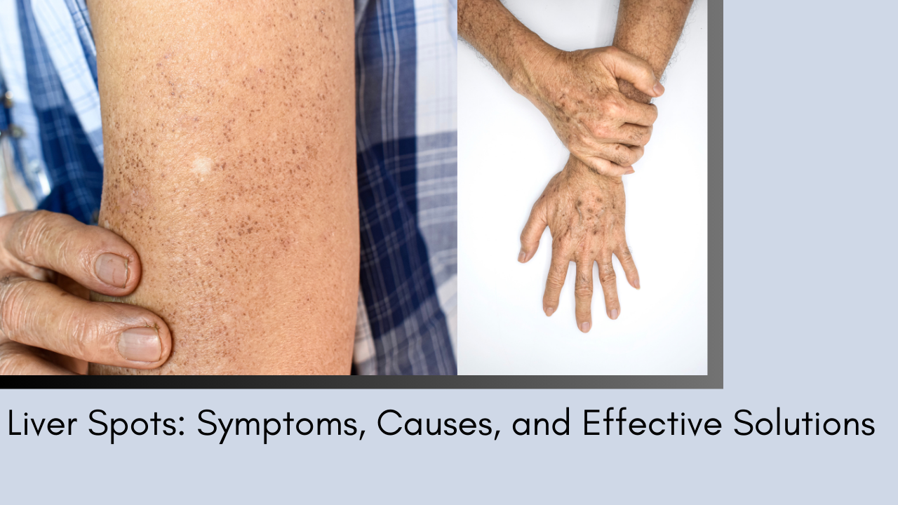 Liver Spots: Symptoms, Causes, and Effective Solutions